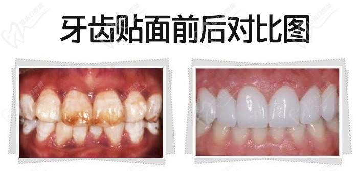 我做牙齒貼面5年后感受，看瓷貼面效果圖