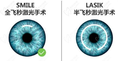 昆明近視手術(shù)哪家醫(yī)院好？