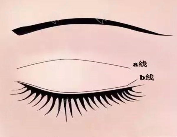 西安雙眼皮孫峰為啥火？揭秘自然媽生款雙眼皮背后的技術(shù)密碼