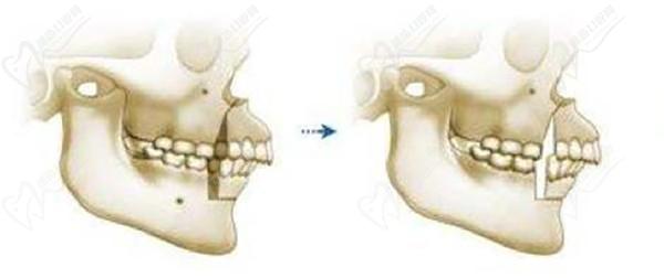2025東莞正頜手術(shù)費(fèi)用一般是多少錢(qián)？含公立私立醫(yī)院價(jià)格表及技術(shù)優(yōu)勢(shì)對(duì)比