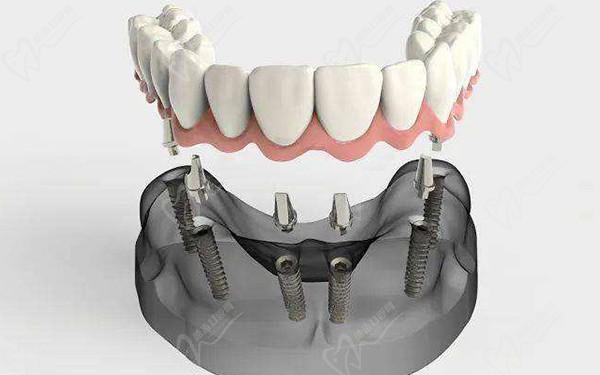 沈陽(yáng)十大種植牙醫(yī)院名單：種牙口碑好與技術(shù)靠譜的完美結(jié)合，均可在線(xiàn)預(yù)約